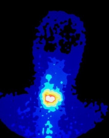 Coloured SPECT scan of thyroid cancer